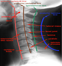 Is It the Age at Disease Onset or the Disease Radiological Severity That Affects Cervical Spine Involvement in Patients With Rheumatoid Arthritis?